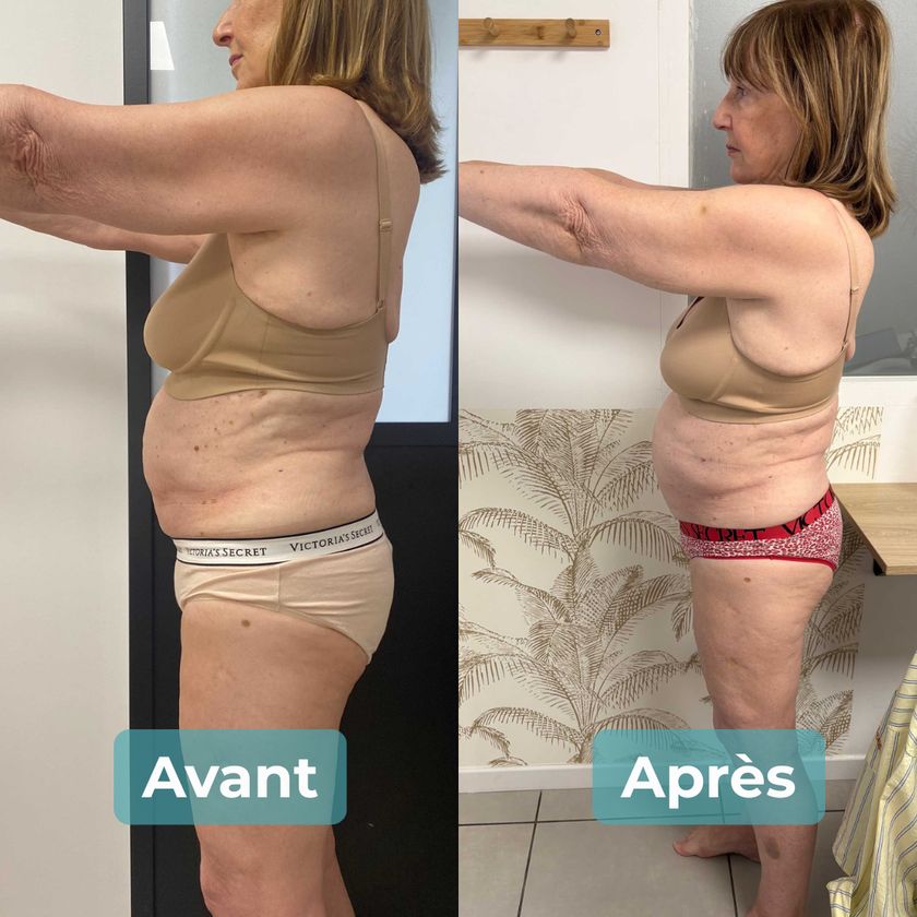 Photo avant et après un accompagnement MAbeautyplus